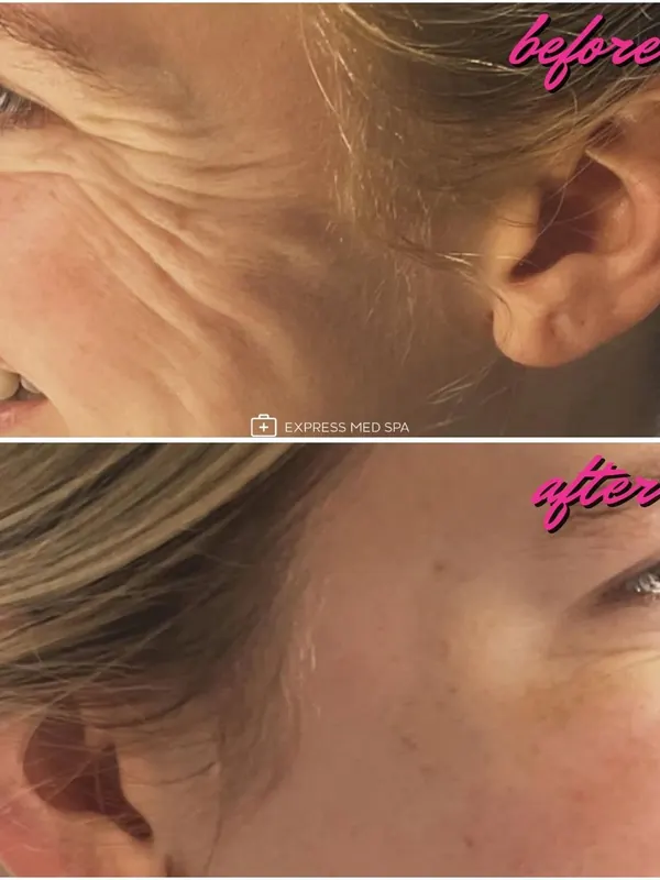 Before and after Botox for crow’s feet, 20 units — Express Med Spa