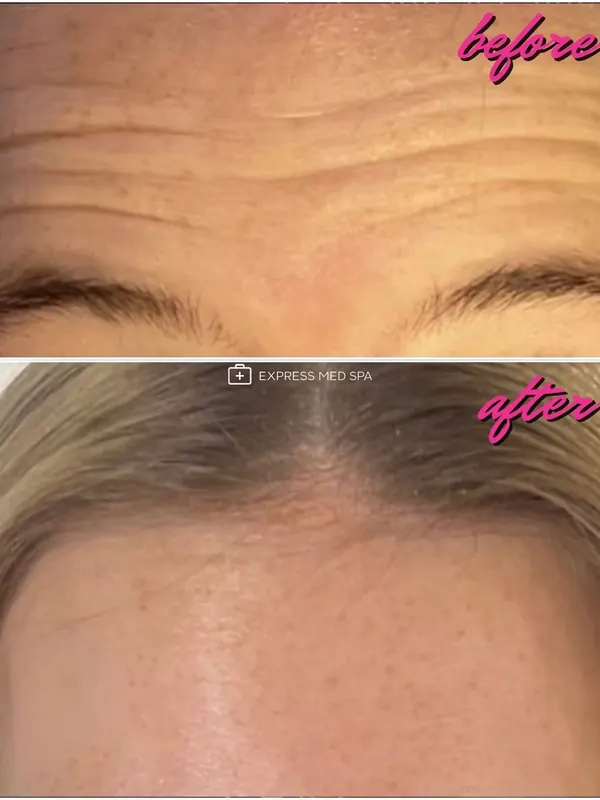 Before and after Botox for forehead lines, 12 units — Express Med Spa