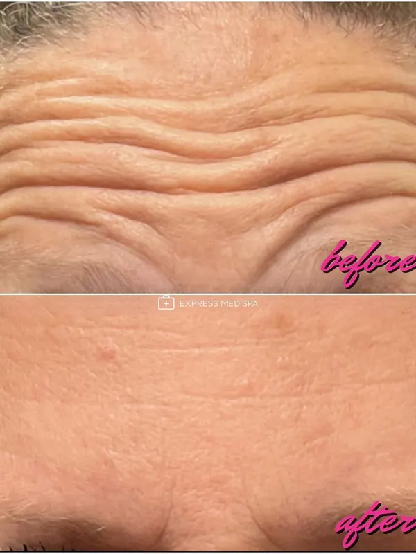 Before and after Botox for forehead lines, 30 units — Express Med Spa