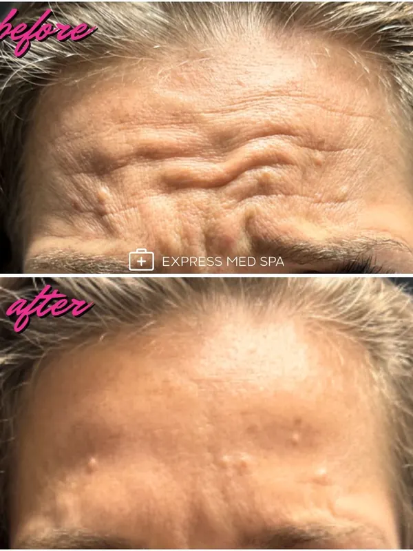 Before and after Botox for forehead lines, 60 units of Xeomin — Express Med Spa