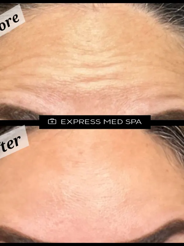 Before and after neurotoxin treatment for forehead lines — Express Med Spa