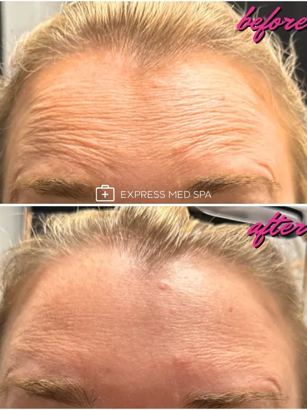 Before and after Xeomin for forehead lines — Express Med Spa
