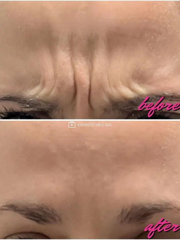 Before and after Botox for frown lines between the brows, 20 units — Express Med Spa