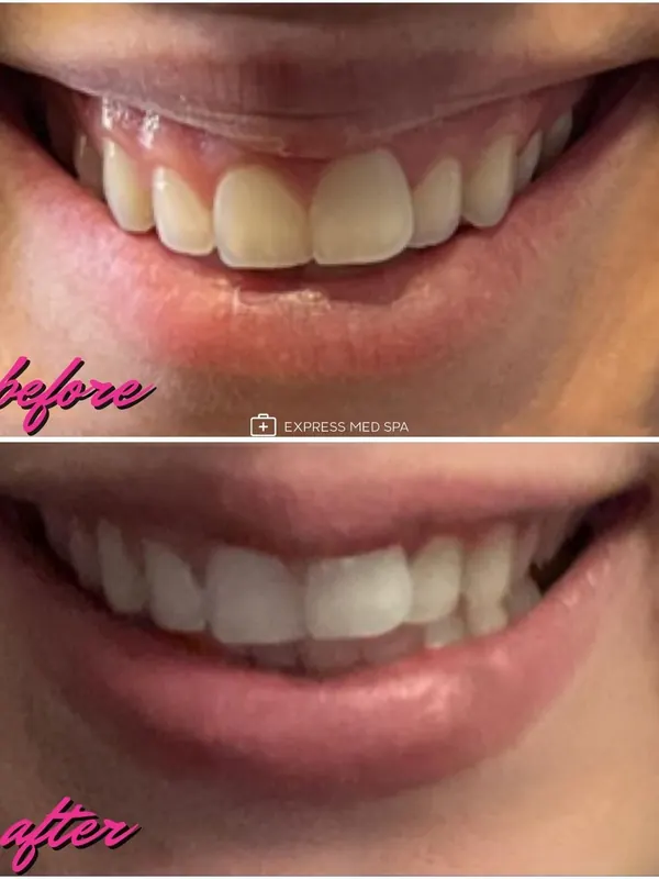 Before and after Botox for a gummy smile, 4 units — Express Med Spa