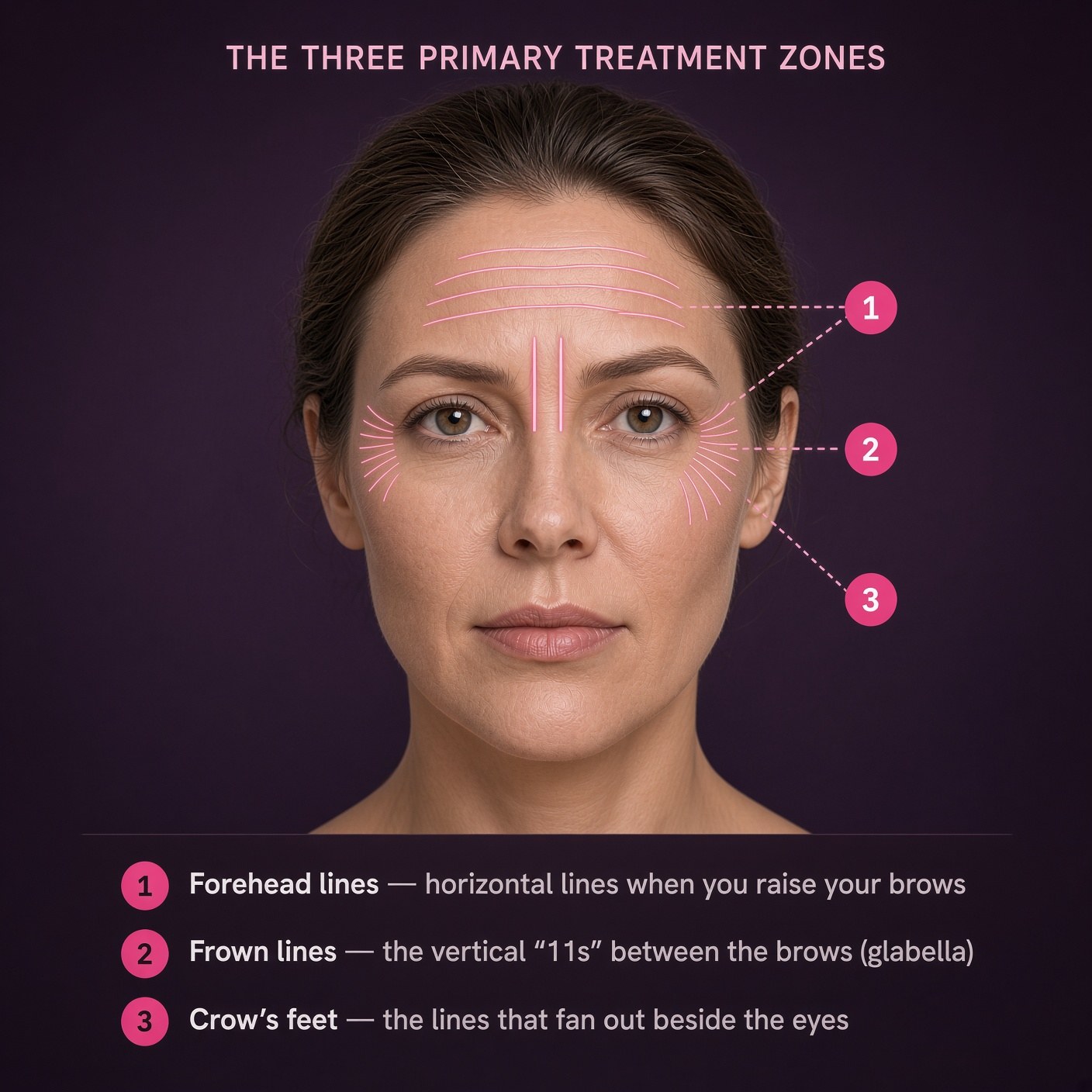Clinical facial diagram showing the three primary Botox treatment zones in Frankfort, IL: forehead lines, frown lines between the brows, and crow's feet